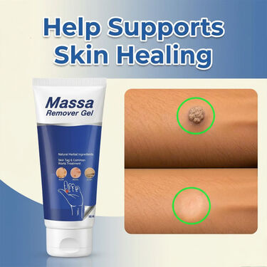 Massa Remover Gel (BCMR).