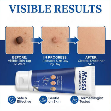 Massa Remover Gel (BCMR).